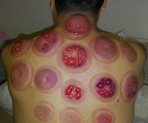 Cupping gone wrong